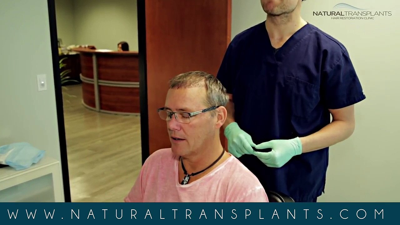 Natural Hair Replacement 10 Day Post Procedure - Natural Transplants Boca Raton (Mike)