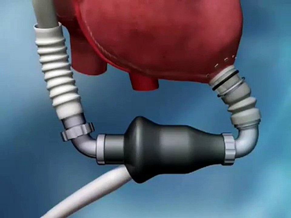 Thoratec heart pump animation