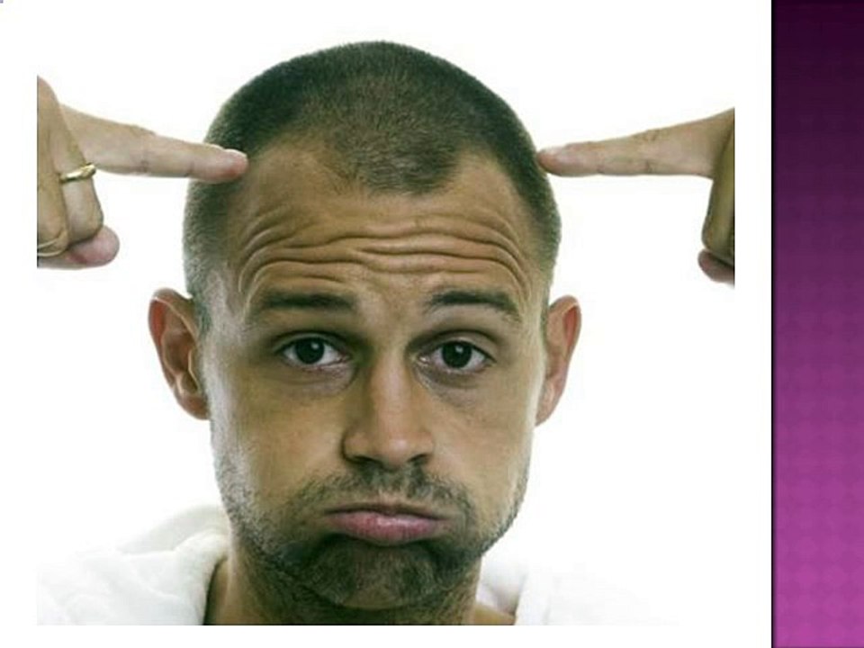 The Male Pattern Baldness