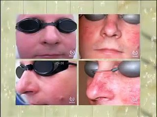 Veido raudonio ir kapiliarų gydymas