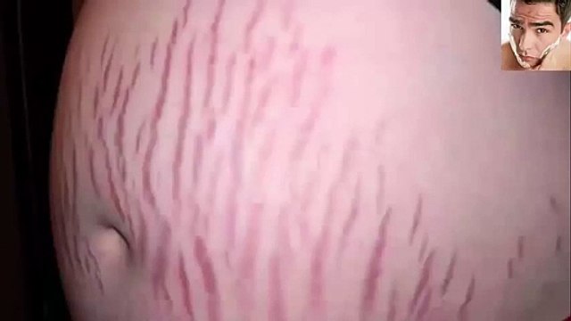 Como quitar las estrias naturalmente con remedios caseros