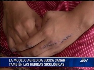 Modelo agredida en zona rosa habla de su proceso de recuperación