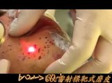 Active FX Laser Acne Scar Removal(ActiveFX活躍飛點CO2雷射標靶式磨皮除痘疤)