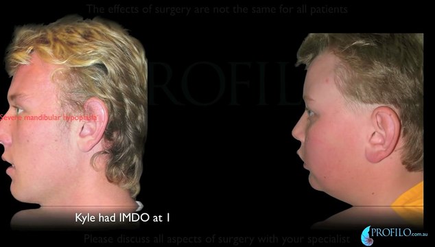 Before and After Orthognathic Jaw Surgery Overbite Underbite Profilo Braces