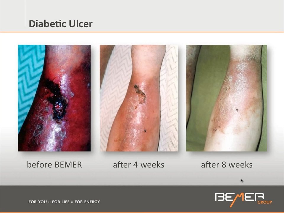 30 minutes webinar  What is the BEMER Technology with Anne Bernard L AC, Naturopath