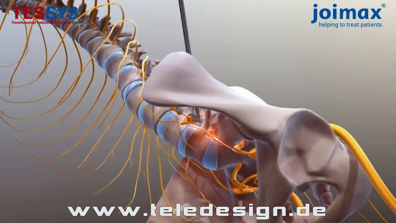 DB 116 Bandscheiben Operation - PAL 16:9 / DB 116 Disc Surgery - PAL 16:9