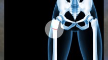 Fosamax, Actonel, Boniva Bone Fractures: Bisphosphonates and Sudden Bone Breaks