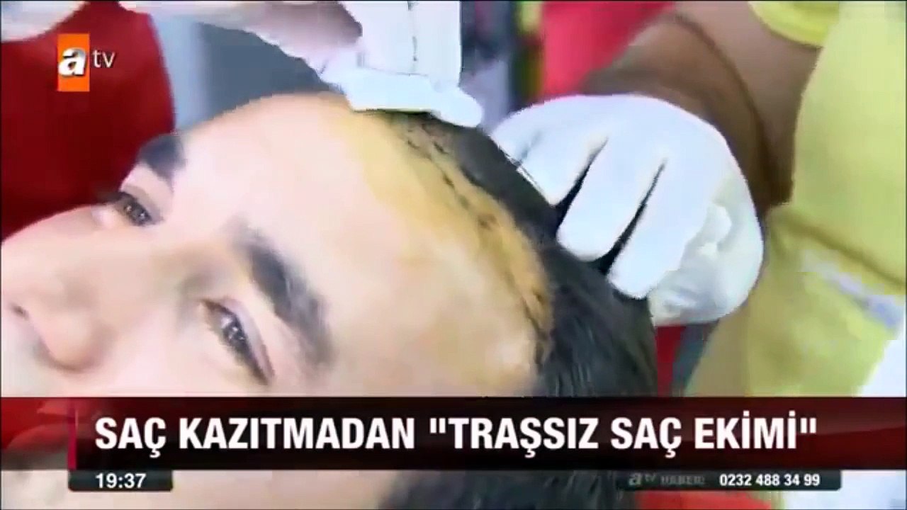 Traşsız Saç Ekimi (Saç Kazıtmadan) Esteworld'de!