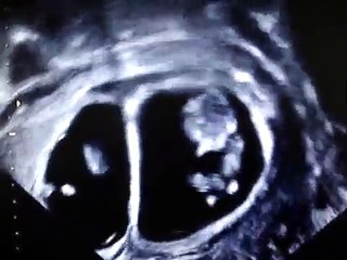 10 WEEKS TWIN PREGNANCY SCAN :)