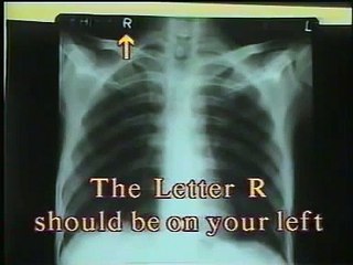 Badanie RTG klatki piersiowej - jak czytać zdjęcie [diagnostyka.multimedis.pl]