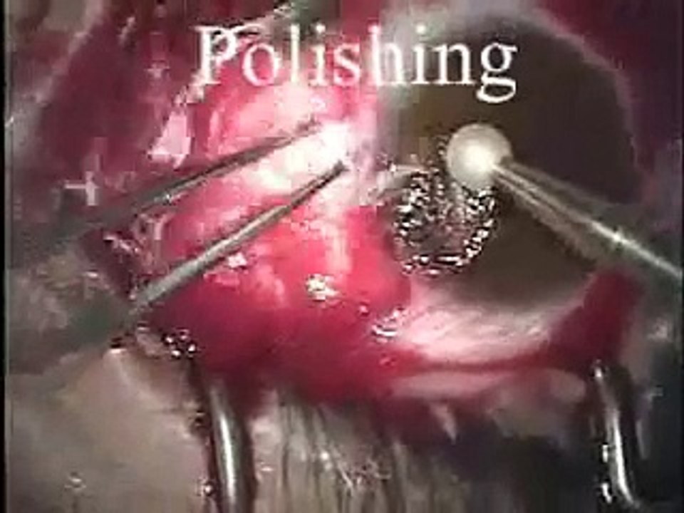 Ptergium - EyePlastics