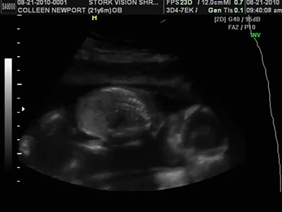 19 weeks pregnant with baby boy Ultrasound