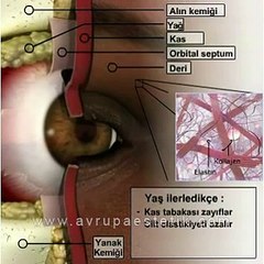 Download Video: Üst Göz Kapağı Estetiği Ameliyat Videosu, Op. Dr. Nazmi Bayçın