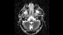 Magnetic resonance imaging of the human brain