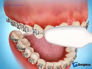 Técnica de Cepillado con encías inflamadas