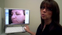 Laser Skin Resurfacing Pre Treatment Evaluation With VISIA Skin Care Analysis