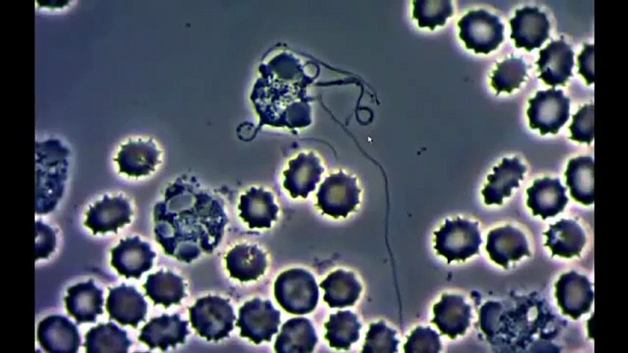 4.Live Blood Infested white blood cells with parasites - video Dailymotion
