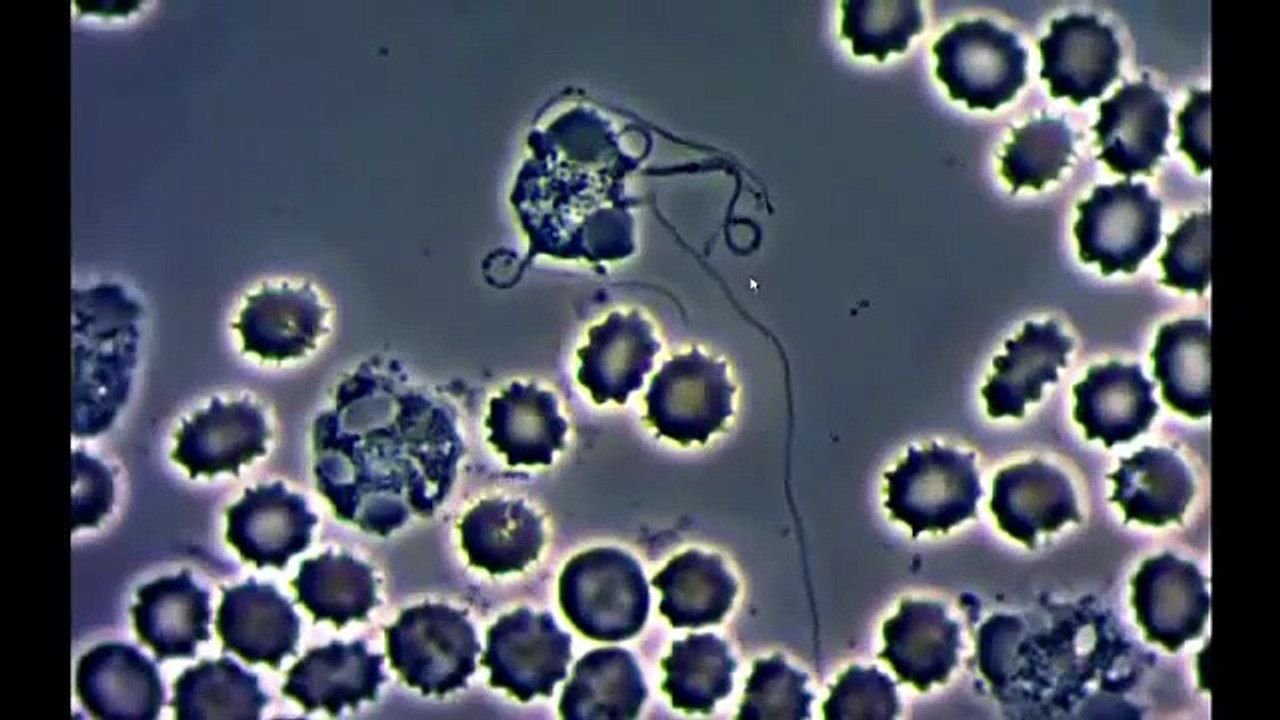 4.Live Blood Infested white blood cells with parasites