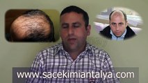 Saç Ekimi Öncesi Sonrası Sonuçlar - Hair Transplantation Before After