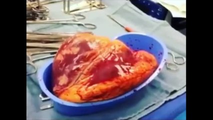 Herz auf Kokain: Dieses Herz zuckte 25 min nach Entnahme immer noch!