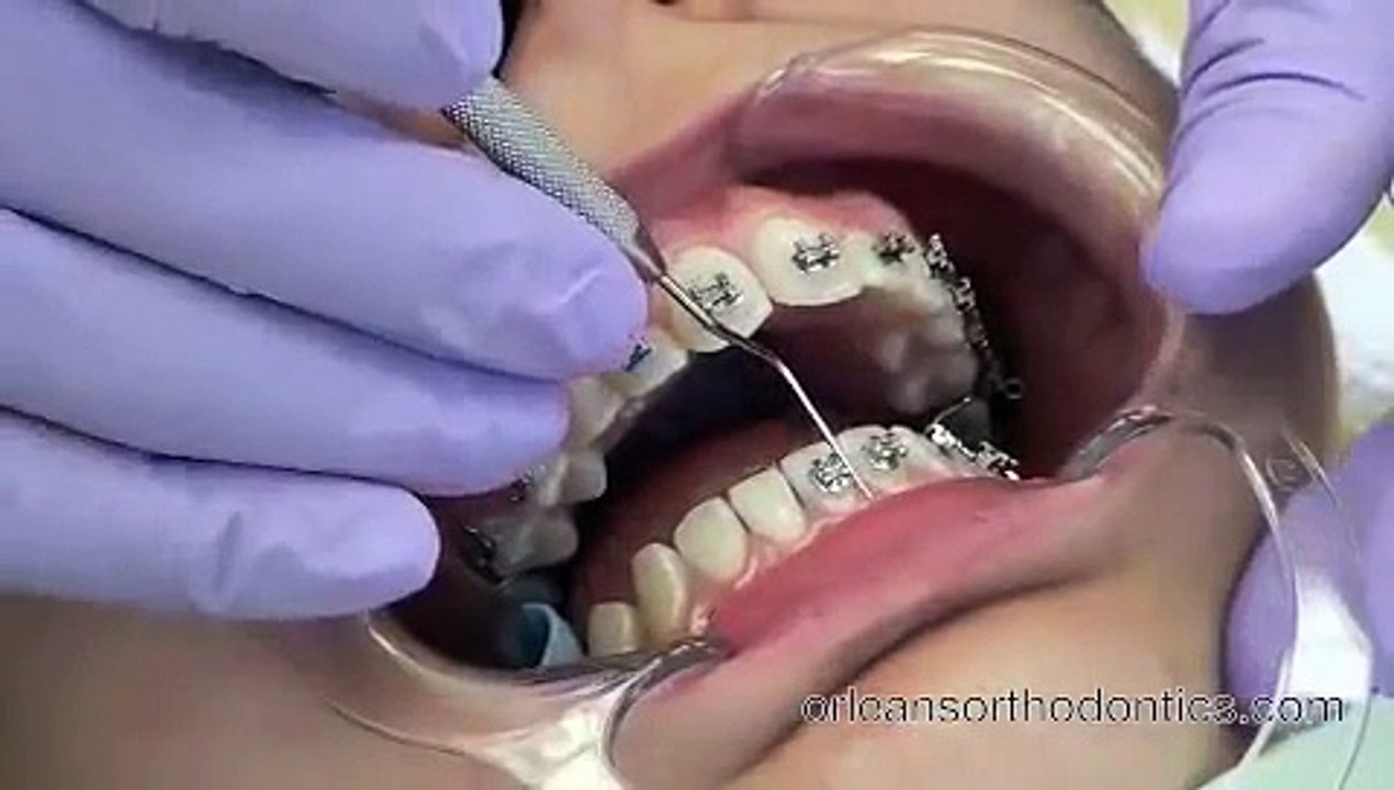 Getting Braces On at Orleans Orthodontics -  Cool French Video!!!