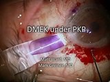 DMEK under PKP Using a modified Jones Tube Glass Injector