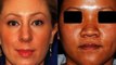 Ethnic Nose Job Before and Afters: Learn How Asian and Caucasian Noses Differ