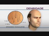 Clinica Ruston - Transplante Capilar - Densidade e volume / Hair Transplant - Density