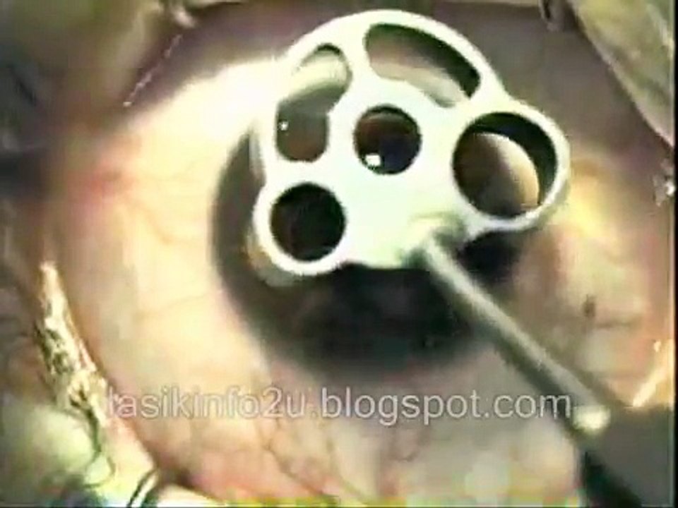 WHAT IS LASIK EYE SURGERY? VIEW LASIK VIDEO NOW!!!