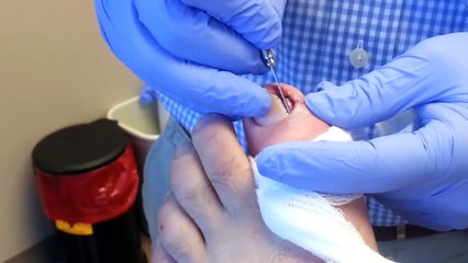 Ingrown toenail removal