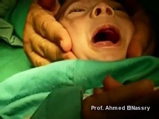Feeding Obturatore for Ellias 4 month baby with Cleft Palate, Clinical Pediatric Dentistry