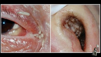 Maggots removed from woman’s nose and eye after fly lays eggs in intensive care