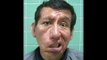 PARALISIS FACIAL IRRECUPERABLE-CORRECCION QUIRURGICA