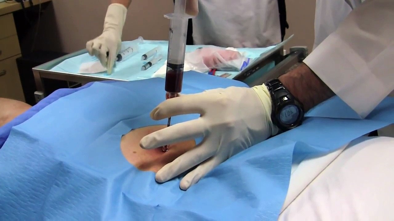 Stem Cell Injection Therapy for Hip Osteoarthritis