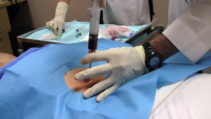 Stem Cell Injection Therapy for Hip Osteoarthritis