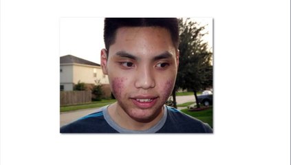 Acne No More Review, is it a scam