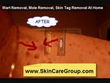 How To Remove Skin Tags,Warts and Moles From Home