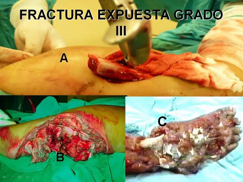 FRACTURAS EXPUESTAS AUDIO CQA.mp4