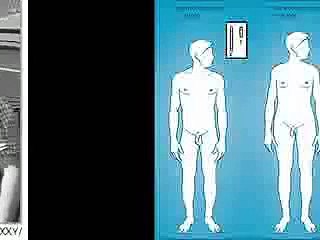 Klinefelter Syndrome