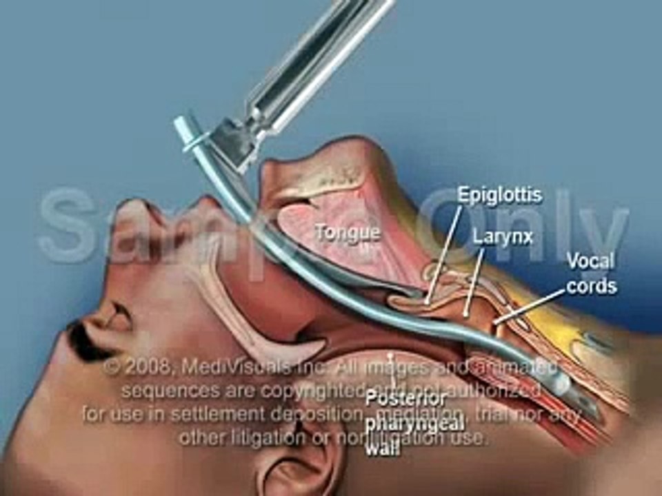 Endotrakeal Entübasyon