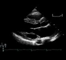Systolic anterior motion of the mitral valve