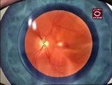 Glaucoma Diagnosis