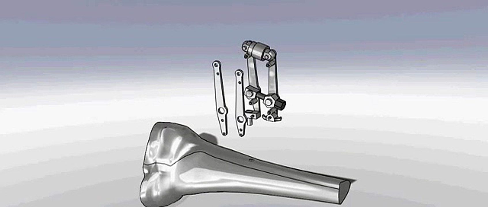 Exploded view of Synthes Articulated Tension Device