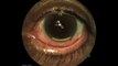 Ozurdex Anterior Chamber Migration What to Do and When to Expect it? Pedro Neves