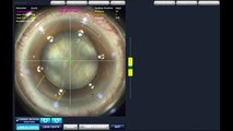 Femtosecond laser surgery in a complex cataract case -- Dr. Mahipal Sachdev