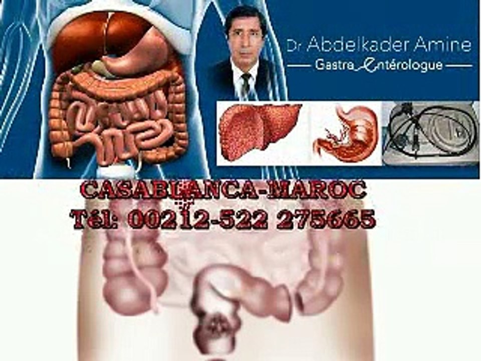 CANCER du rectum ,traiement  : chimiothérapie , radiothérapie, chirurgie