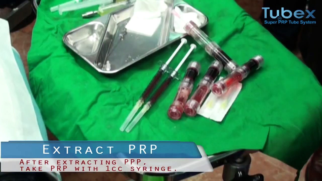 PRP(Platelet Rich Plasma) Therapy with TUBEX [MOOHAN Enterprice]