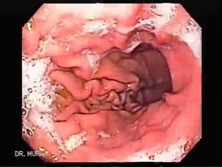 Endoscopy of Upper GI Tract