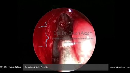 Endoskopik sinüs cerrahisi - Op. Dr. Erkan Aktan