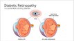 Diabetic Eye Disease | Diabetic Retinopathy